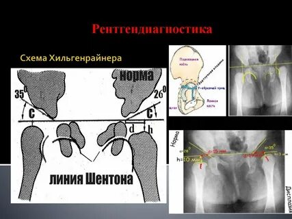 Врожденный подвывих
