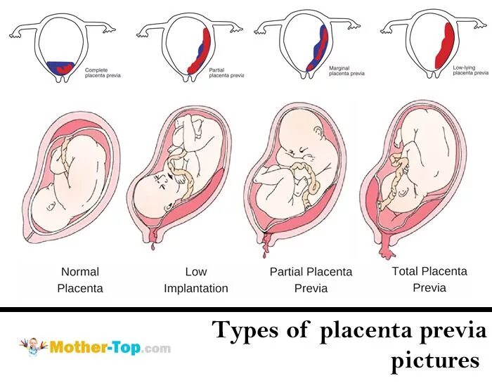 При низкой плацентации можно. 5. Классификация предлежания плаценты.. Центральное боковое и краевое предлежание плаценты. Шеечное предлежание плаценты. Краевое прикрепление пуповины к плаценте.
