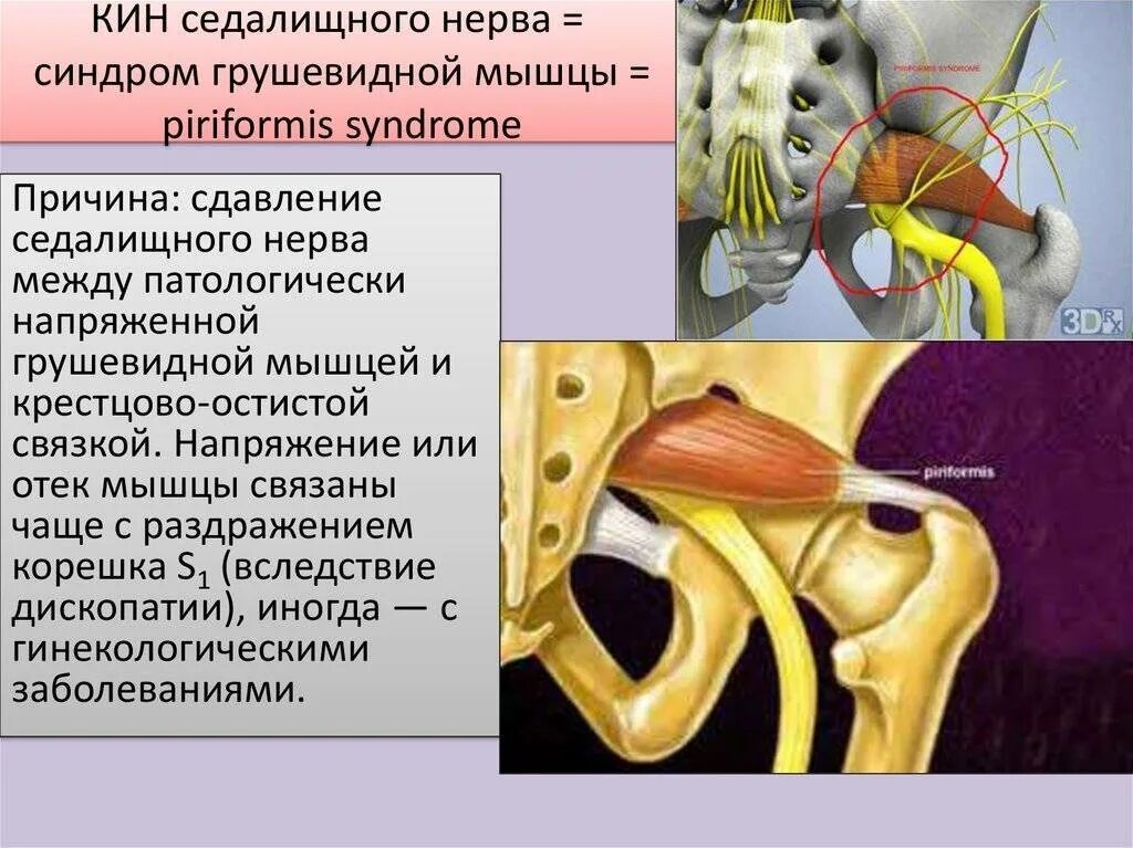 Синдромы мышц. Грушевидная мышца и седалищный нерв. синдром грушевидной мышцы. тазовый нерв. синдром седалищного нерва.