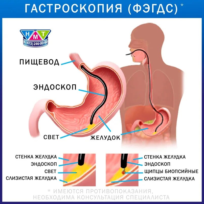 Эгдс и фгдс в чем разница что. Гастроскопия. Эзофагогастродуоденоскопия памятка. Гастроскопия желудка. Эзофагогастродуоденоскопия подготовка.