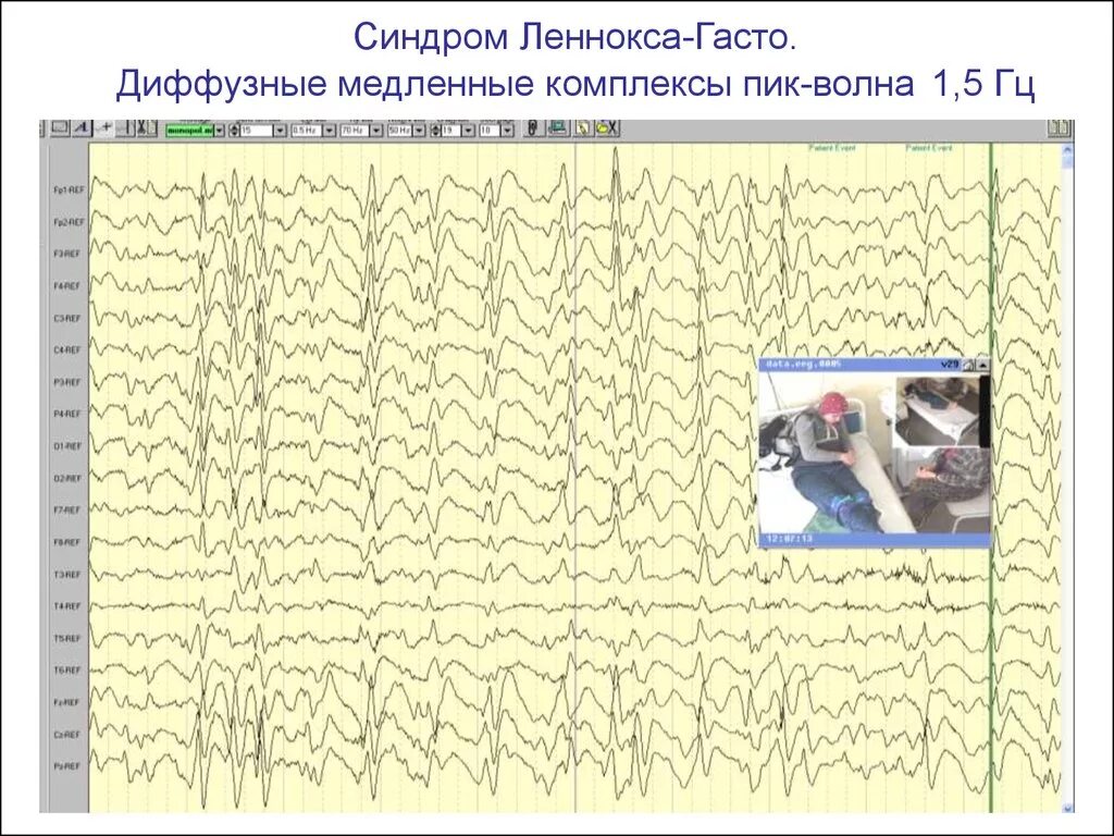 Синдром Леннокса-Гасто ЭЭГ. Миоклоническая эпилепсия ЭЭГ. ЭЭГ эпилепсия пик-волна. Комплексы пик волна на ЭЭГ. Медленные волны на ээг