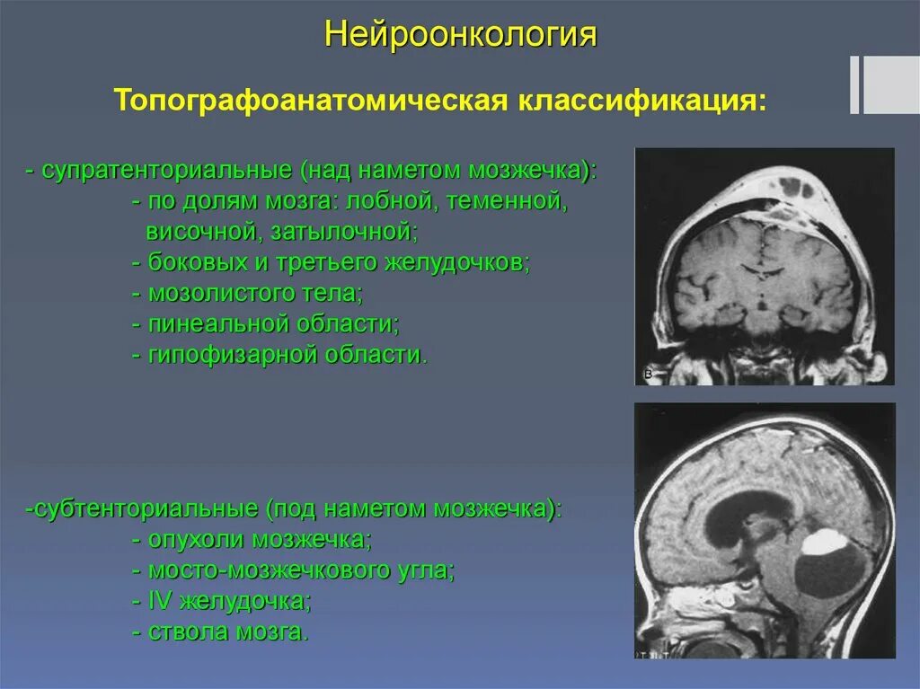 Новообразование в головном мозге. Опухоли мозга классификация. Классификация глиом головного мозга. Мозжечковая опухоль