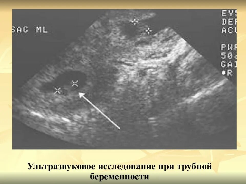 Когда можно увидеть беременность. Внематочная Трубная беременность УЗИ. Ультразвуковое исследование беременности на ранних сроках. Внематочная беременность в трубе УЗИ. УЗИ внематочной беременности на раннем сроке.