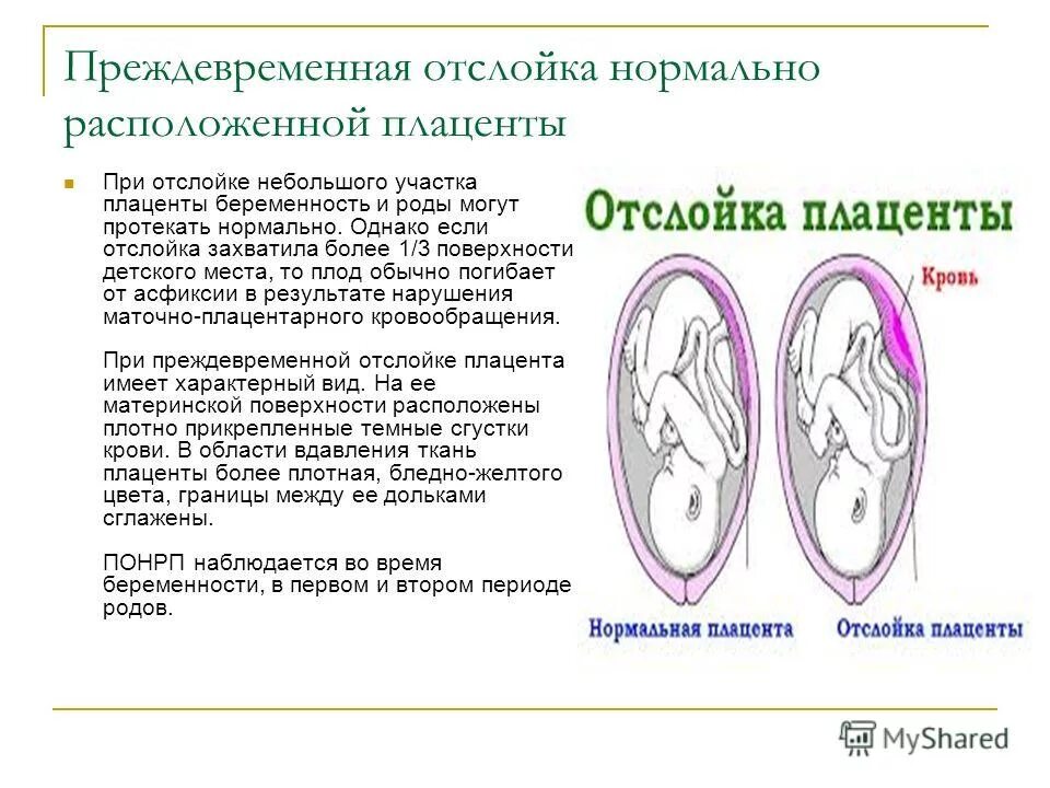 Отслойка нормально расположенной плаценты симптомы. Симптомы отслойки плаценты на 7 неделе беременности. Что такое плацента отслойки плаценты при беременности. Отслойка плаценты при беременности в 1 триместре.