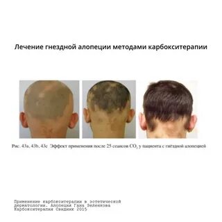 Гнездная алопеция клинические рекомендации