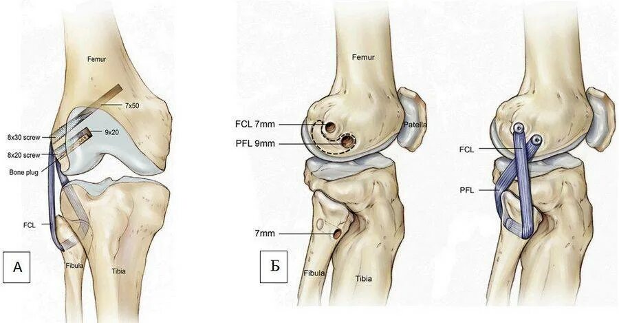 Латеральная коллатеральная связка коленного. Операция пластика ПКС коленного сустава. Операция пластика крестообразной связки. Пластика наружной боковой связки коленного сустава. Разрыв связок коленного сустава ПКС операция.