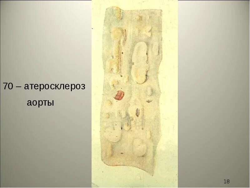 Атеросклероз аорты прогнозы. Ибс атеросклероз аорты. глыбчатый атеросклероз аорты. атеросклероз аорты макрокартина.