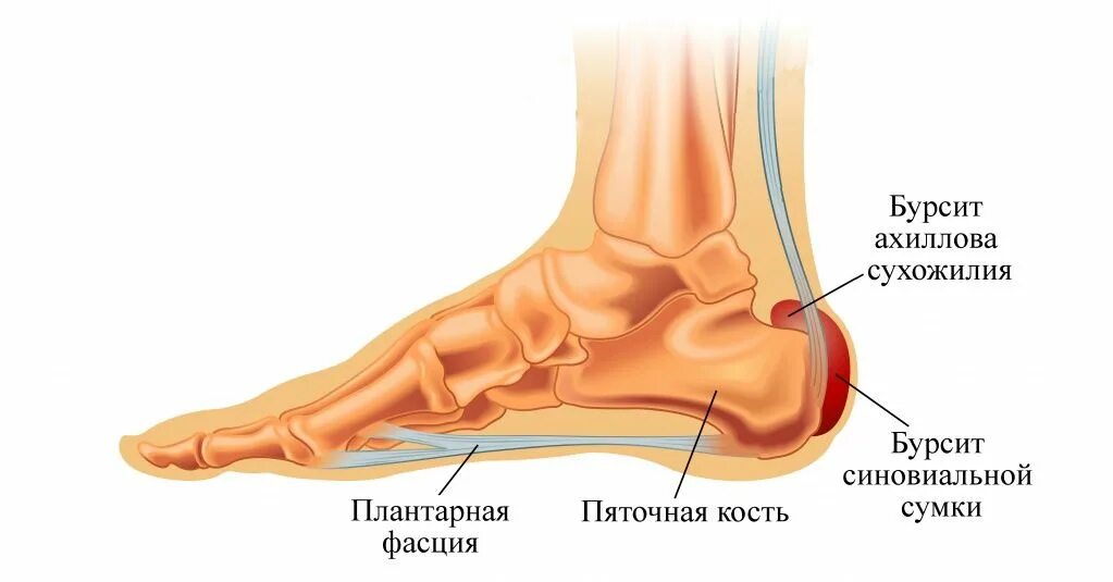 Болит стопа снизу