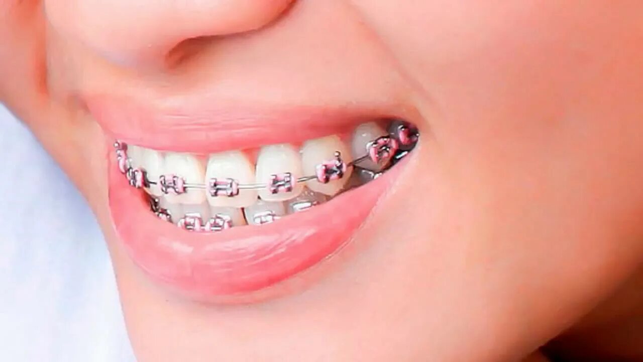 Matching brackets