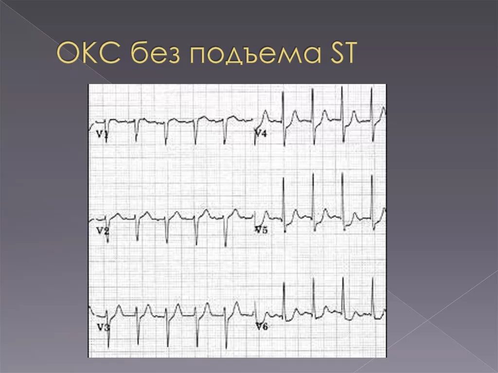 Экг подъем. Окс без подъема St ЭКГ. Окс c подъемом сегмента St ЭКГ. ЭКГ инфаркт миокарда без подъема St. Острый коронарный синдром без подъема сегмента St.