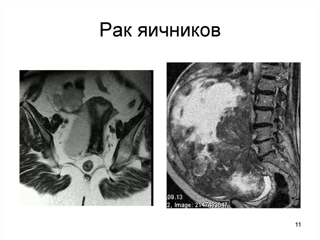 Признаки онкологии яичников. Клинические проявлениерака яичников. Рак яичников почему