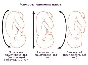 Транспозиция плода
