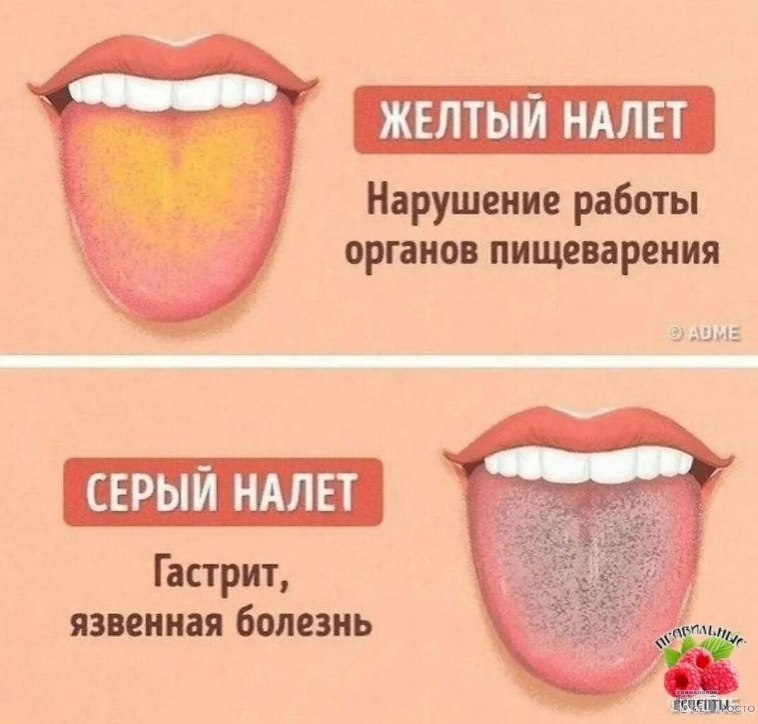 Язык человека определить болезнь. Желучный налет на языке.