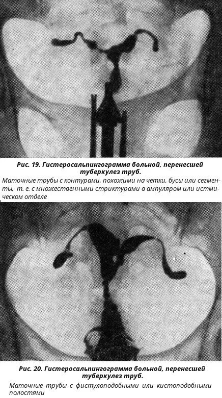 гистеросальпингография (гсг).