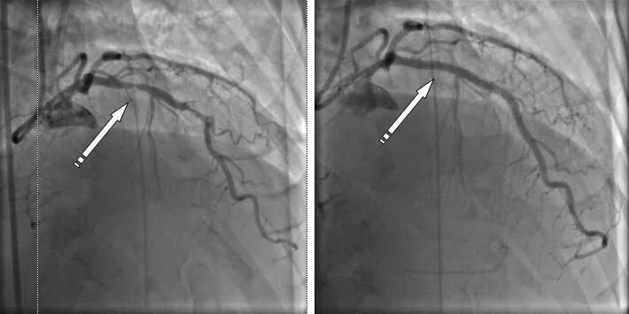 После стентирование самолет. Коронарография стеноз ПМЖВ. Стентирование устья ПМЖВ. ПКА-ЗМЖВ стентирование.