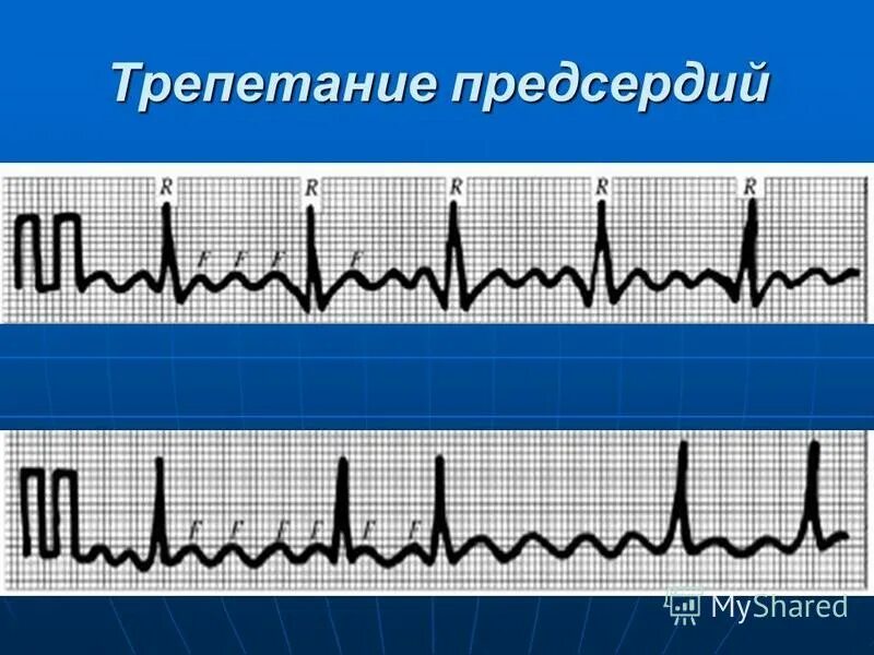 Трепетание предсердий 2 к 1 на ЭКГ. Фибрилляция и трепетание предсердий на ЭКГ. Атипичная трепетание предсердий. Типичное трепетание предсердий. Формы трепетания предсердий