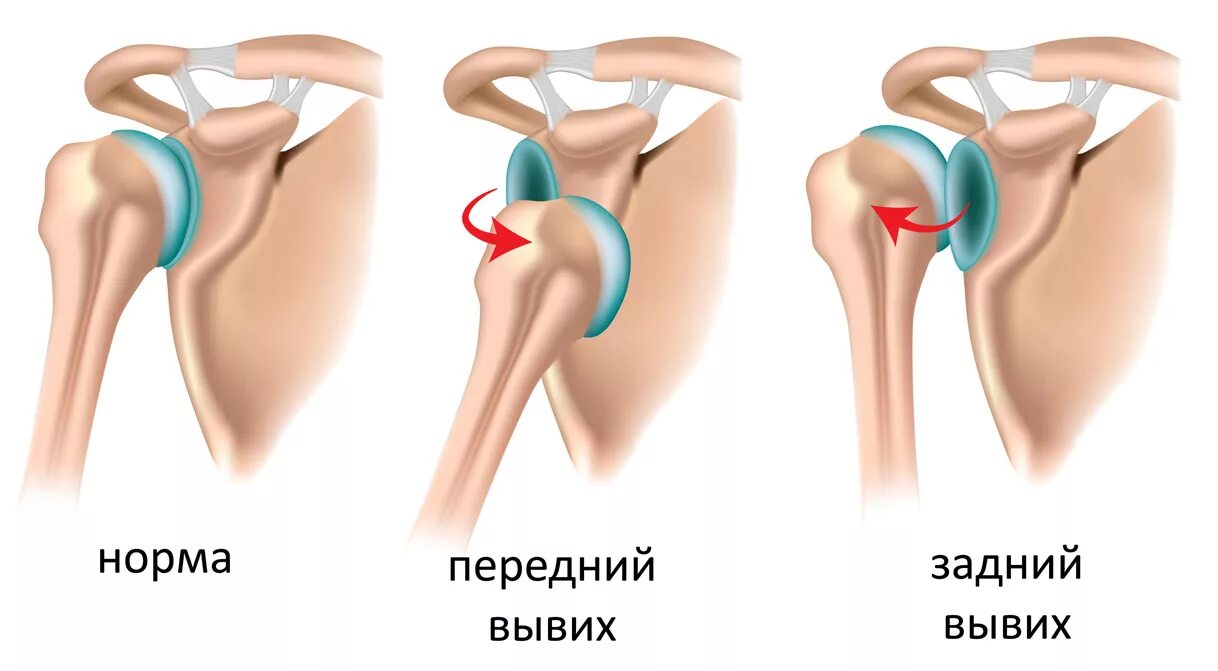 Как выглядит вывих плеча. Подклювовидный вывих плечевого сустава. врожденный вывих плечевого сустава. подвывих плечевого сустава классификация. вывих головки плечевой кости симптомы.