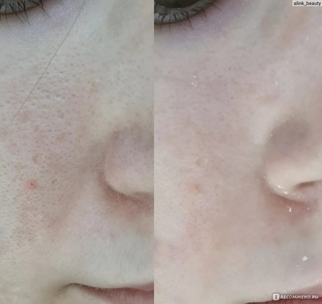 Альгинатная маска до и после. Альгинатная маска эффект до и после. Альгинатные маски до после. Альгинатная маска для лица до и после. Альгинатная маска для лица эффект до и после.