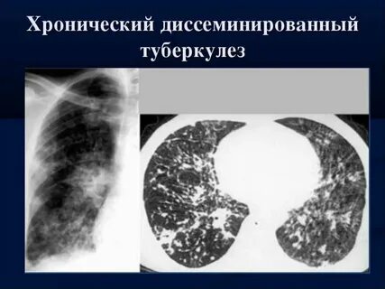 Диссеминированный кавернозный туберкулез