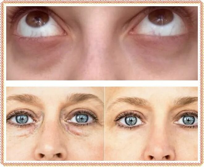 Впалые глаза как выглядят Cómo hacerte un peeling casero The Beauty Effect Tratamientos faciales, Piel,