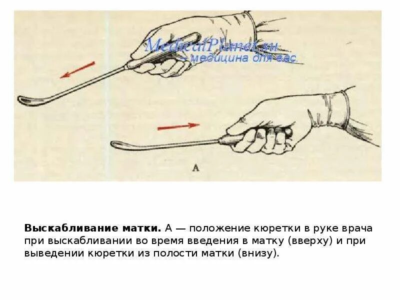Выскабливание полости матки алгоритм. Раздельное диагностическое выскабливание алгоритм. диагностическое выскабливание матки. технику пробного выскабливания полости матки.
