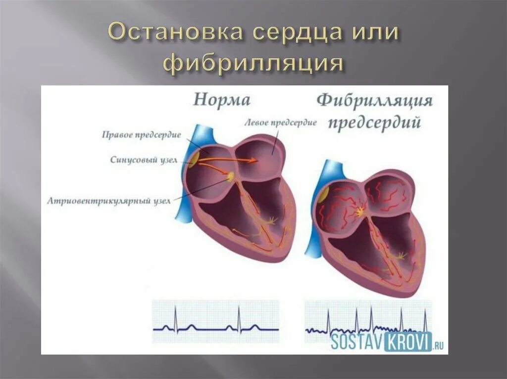 Левое предсердие норма
