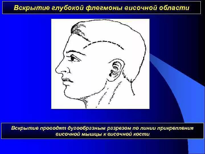 Распространение флегмоны. Распространение флегмоны