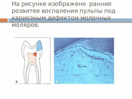 Особенности пульпитов у детей