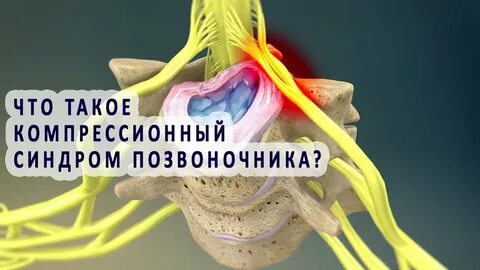 Шейный позвонок защемление нерва