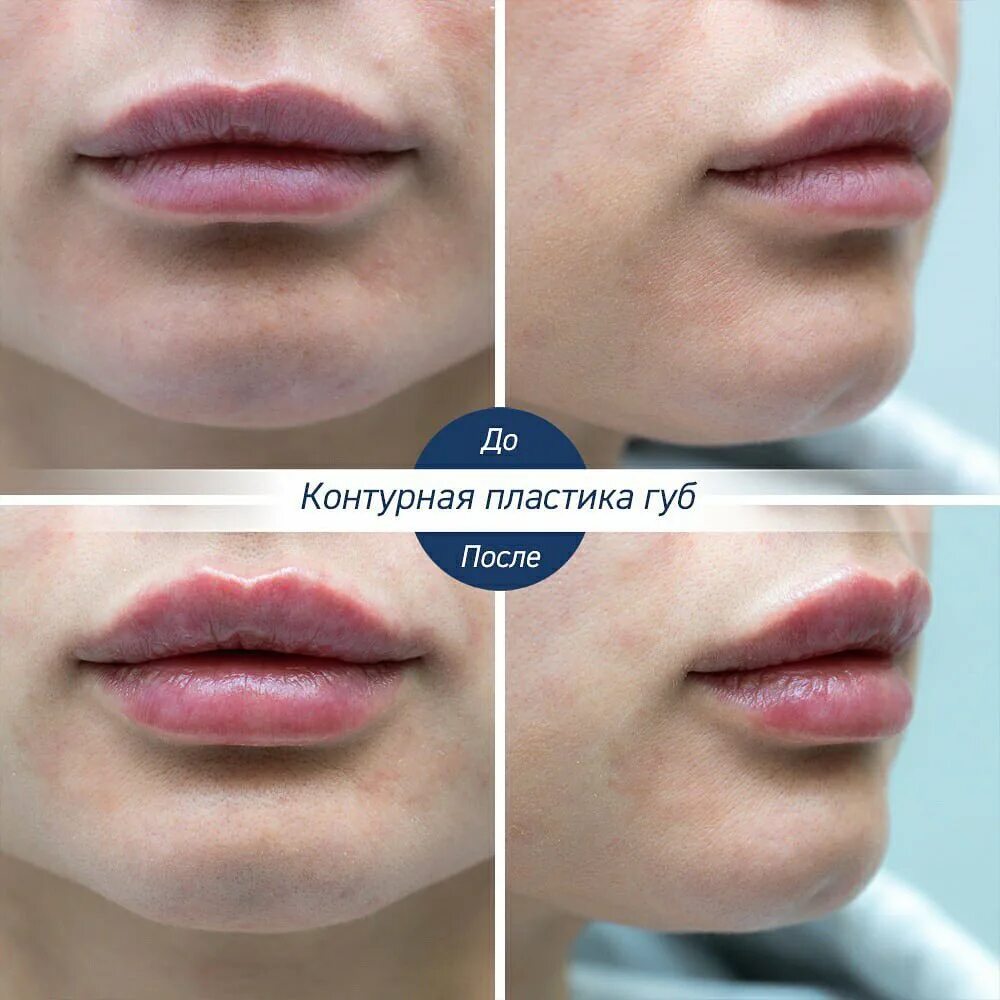 Как увлажнить губы