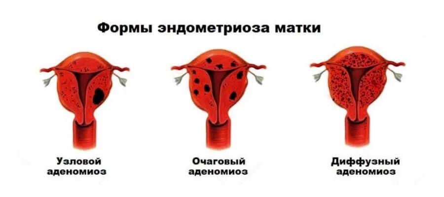 Диффузная матка