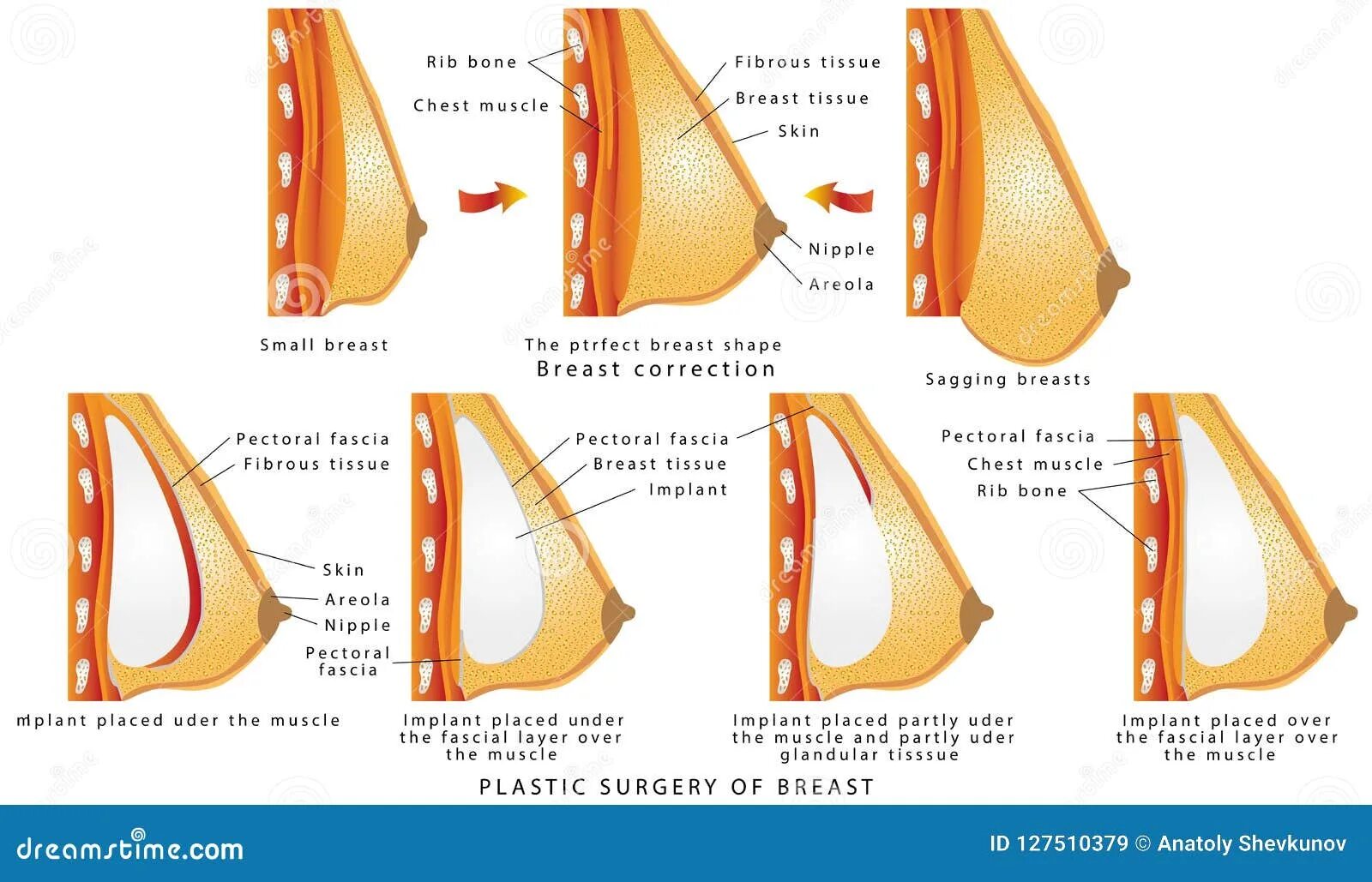 Plastic surgery of breast stock vector. Illustration of chest 127510379