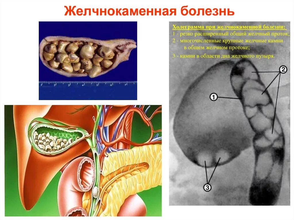 Жкб 1. ЖКБ камни желчного пузыря. Желчекаменная болезнь (ЖКБ). Желчнокаменная болезнь холецистолитиаз. Желчекаменная болезнь образование камней.