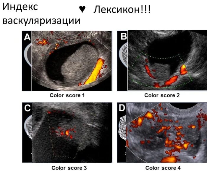 О РАДС классификация УЗИ яичников. Васкуляризация эндометрия 3 балла. Классификация o-rads для УЗИ. O rads классификация. O rads 4