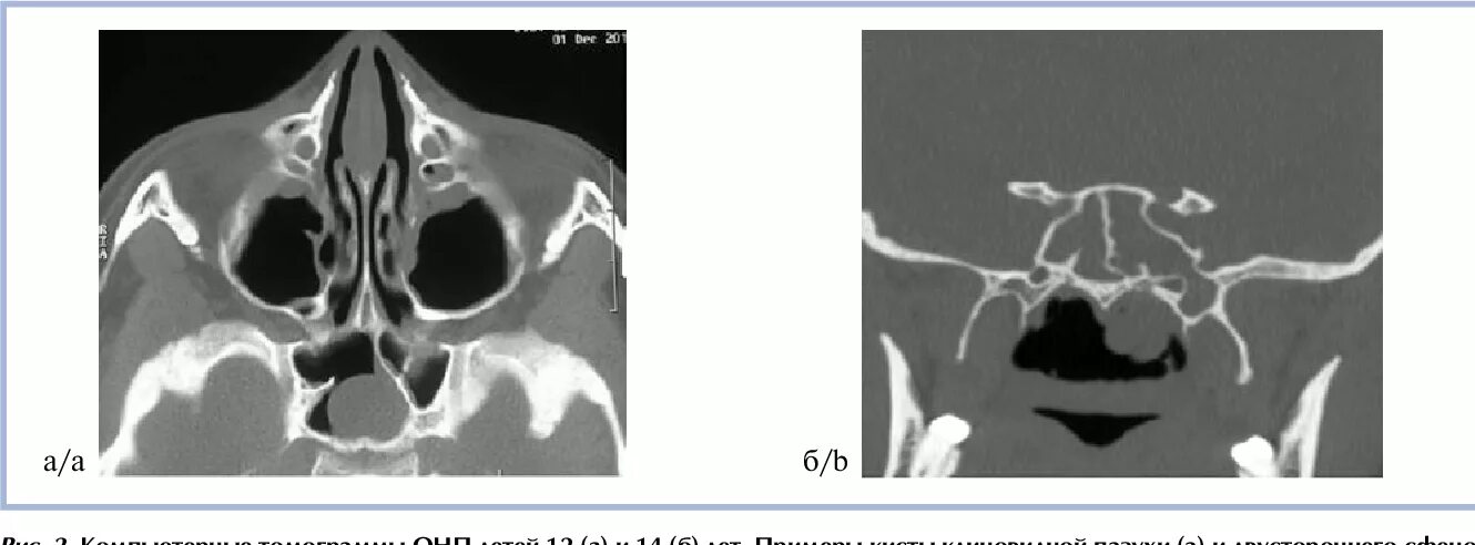 Сфеноидит операция. Хронический сфеноидит на кт. Клиновидная пазуха на кт. Кт пазух носа сфеноидит.