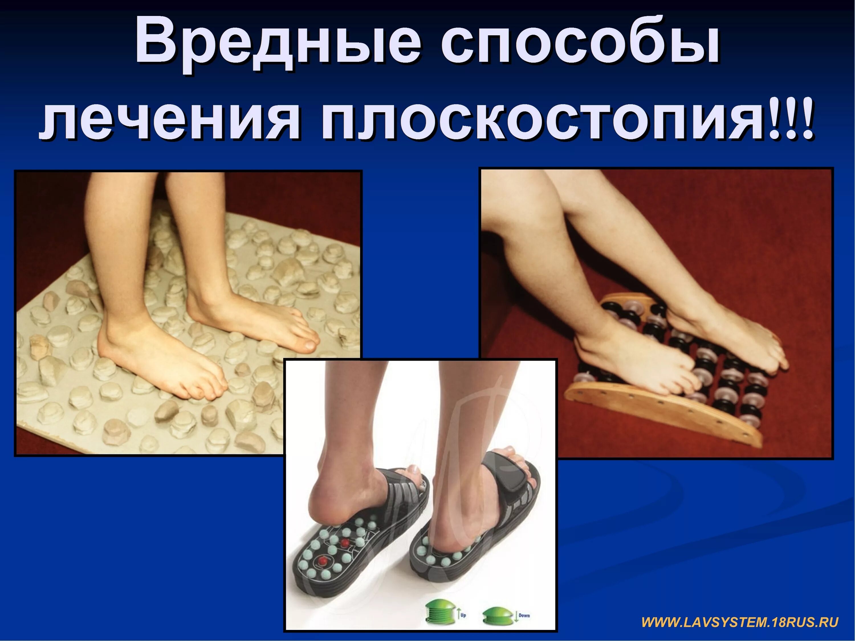 Можно ли избавиться от плоскостопия. Поперечное плоскостопие ii степени. плоскостопие у детей. профилактика плоскостопия у взрослых. причины плоскостопия у детей.