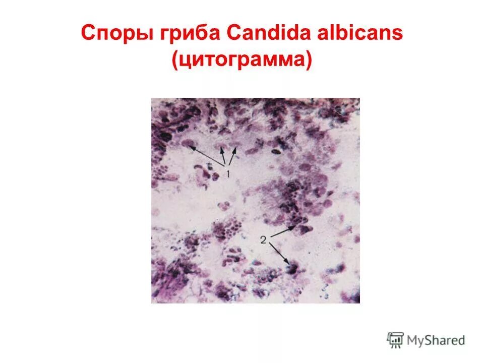 Candida albicans мазок микроскопия. грибы кандида альбиканс микроскопия. грибы кандида микроскопия. хламидоспоры кандида. Candida albicans почкующиеся клетки.