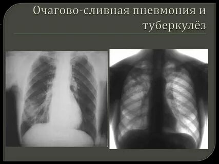 Чем отличается воспаление легких от