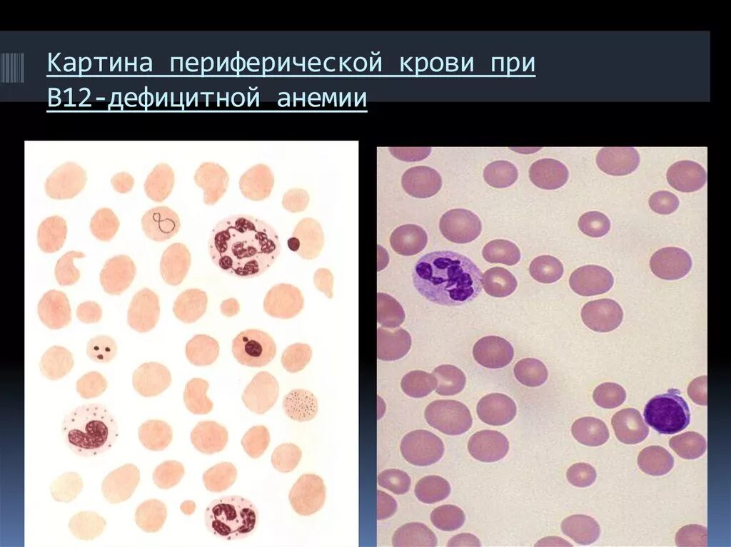 Культивирование лимфоцитов периферической крови. Костный мозг при б12 дефицитной анемии. Б12 дефицитная анемия мазок крови. Мазок крови при в12 фолиеводефицитной анемии. Картина крови при в12 дефицитной.