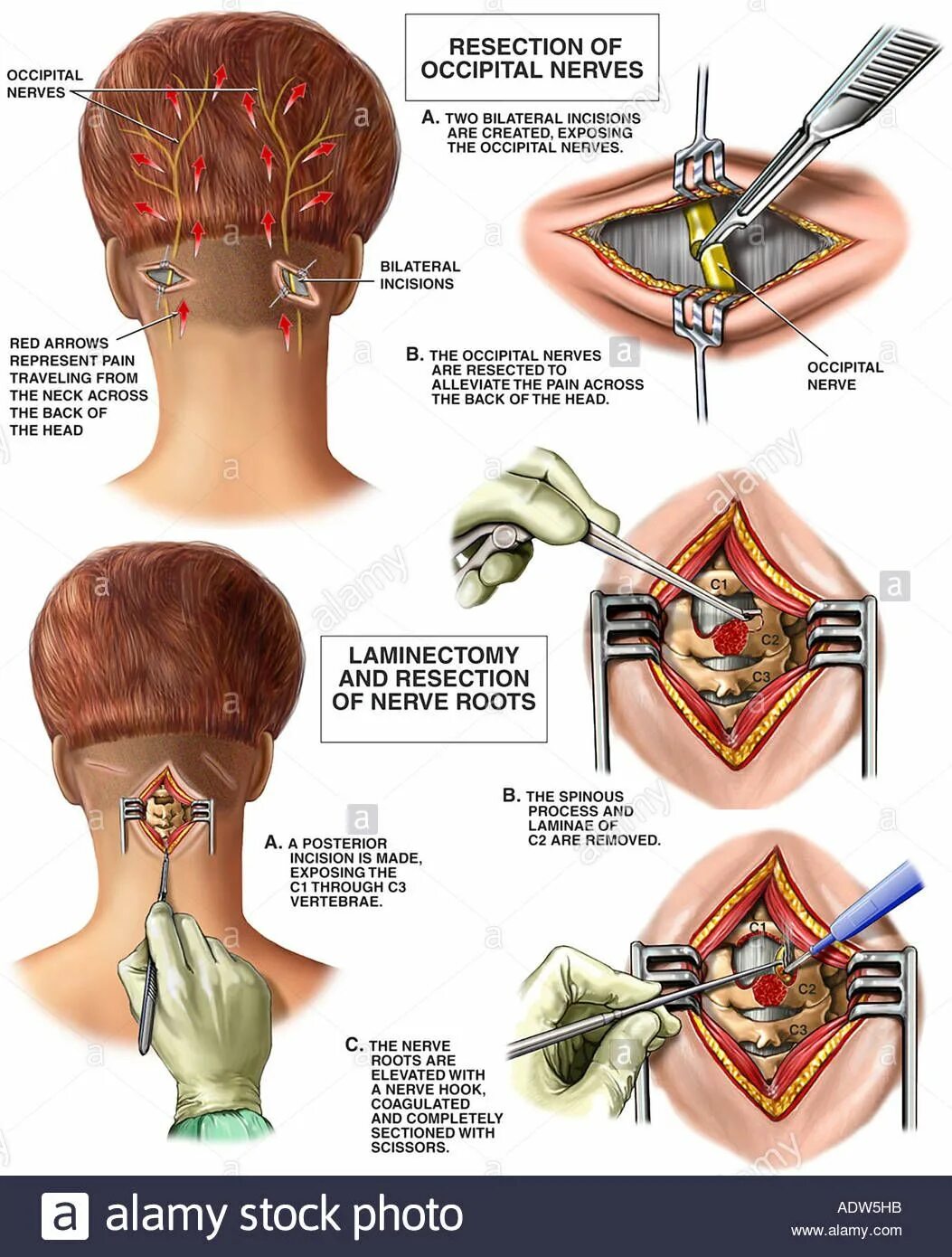 Neuralgia латынь