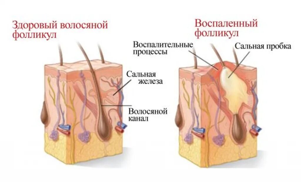 Фолликулит волосяного фолликула. Фурункулез волосяных фолликулов. Фолликулит – воспаление волосяных фолликул.. Фурункул волосяной луковицы. 17 фолликулам