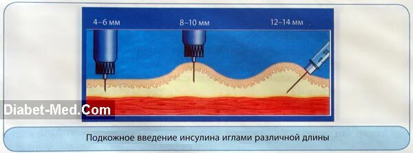 Градусы введения иглы. Угол введения иглы инсулина. Иглы 6-8мм для инъекции инсулина. Техника введения инсулиновым шприц. Правильная постановка инсулина.