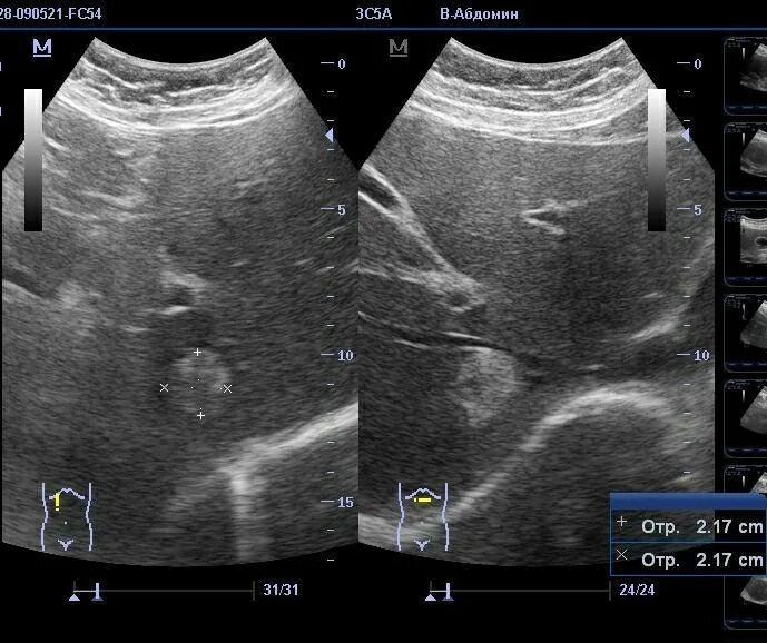Гемангиома в паренхиме печени. Кавернозная гемангиома селезенки УЗИ. Очаговые гемангиомы печени