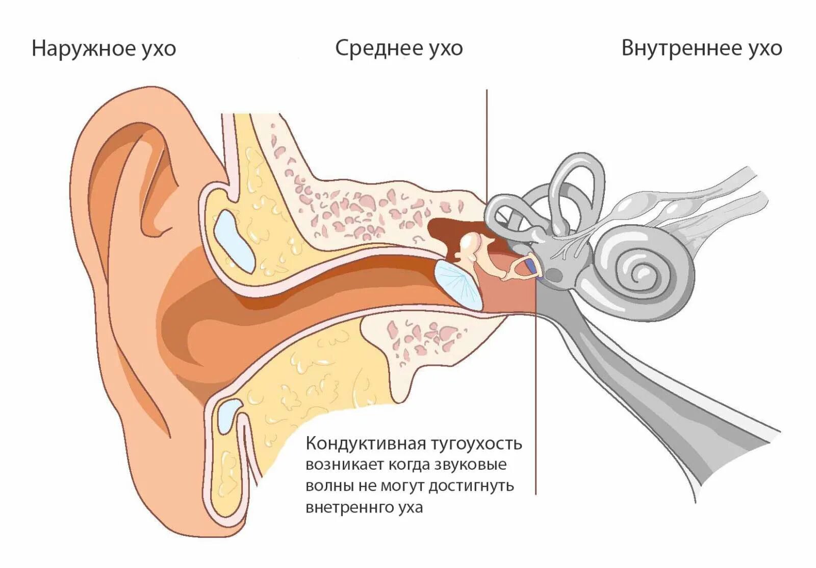 Среднее нарушение слуха. Кондуктивная и сенсоневральная тугоухость. Кондуктивная тугоухость отит. Ушная раковина тугоухость. Атрезия слухового прохода кондуктивная тугоухость.