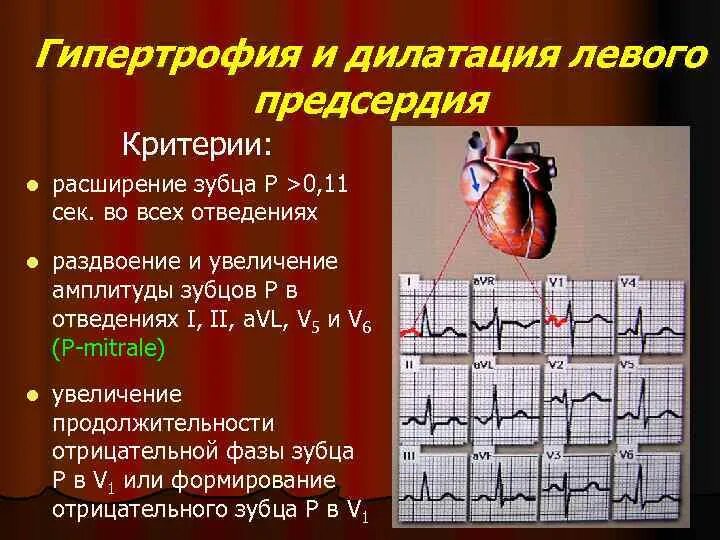 Гипертрофия левого предсердия на ЭКГ. Дилатация ЛП на ЭКГ. Степени дилатации предсердий. Гипертрофия предсердий на ЭКГ. Гипертрофия левого предсердия левого желудочка