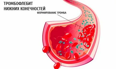 Расплавление тромба