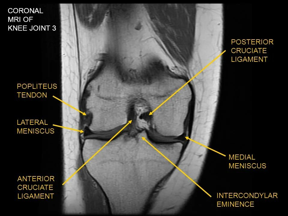 Knee mri. Knee mri. Knee mri. Тендинит коленного сустава на мрт. Knee mri.