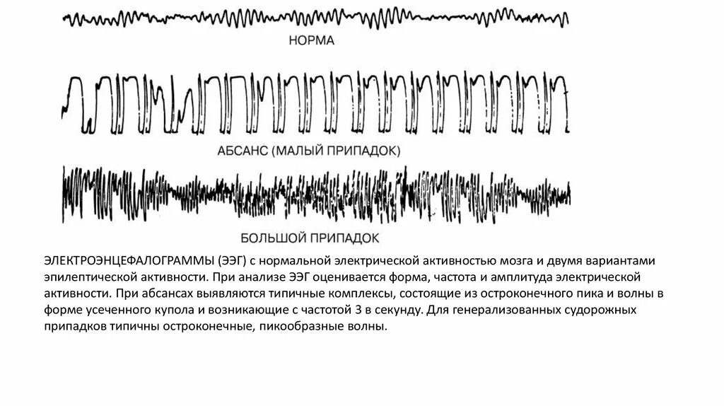 Биоэлектрическая активность головного мозга. Ритмы ЭЭГ.. ЭЭГ при психических расстройствах. Волновое ЭЭГ расшифровка. ЭЭГ волны патологические.