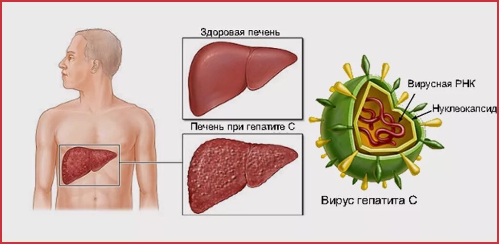 Вирусный гепатит с (ВГС. Печень при вирусном гепатите.