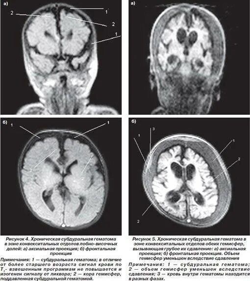 Поражение головного мозга у новорожденных. Субдуральная гематома родовая травма. Субдуральная гематома мозжечка кт. Субдуральное кровоизлияние мрт. Внутричерепная субдуральная гематома мрт.